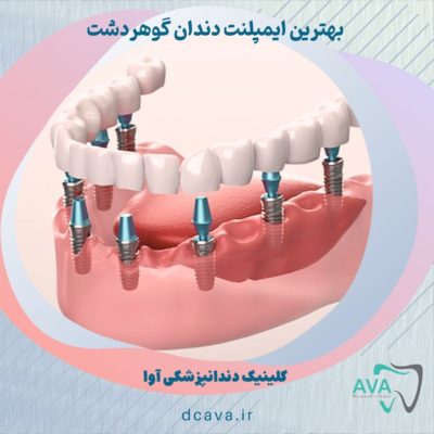 بهترین ایمپلنت دندان گوهردشت 3 ایمپلنت دندان گوهردشت