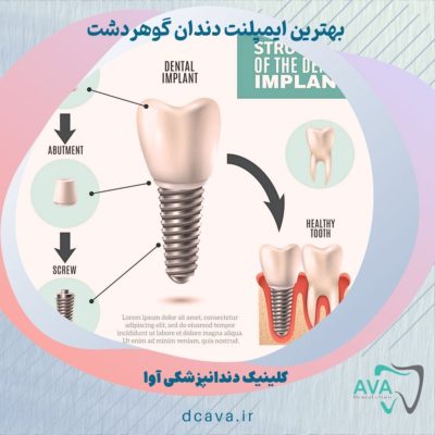 بهترین ایمپلنت دندان گوهردشت 4 ایمپلنت دندان گوهردشت