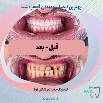 بهترین ایمپلنت دندان گوهردشت 5 ایمپلنت دندان گوهردشت