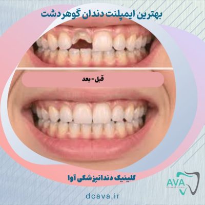 بهترین ایمپلنت دندان گوهردشت 2 ایمپلنت دندان گوهردشت