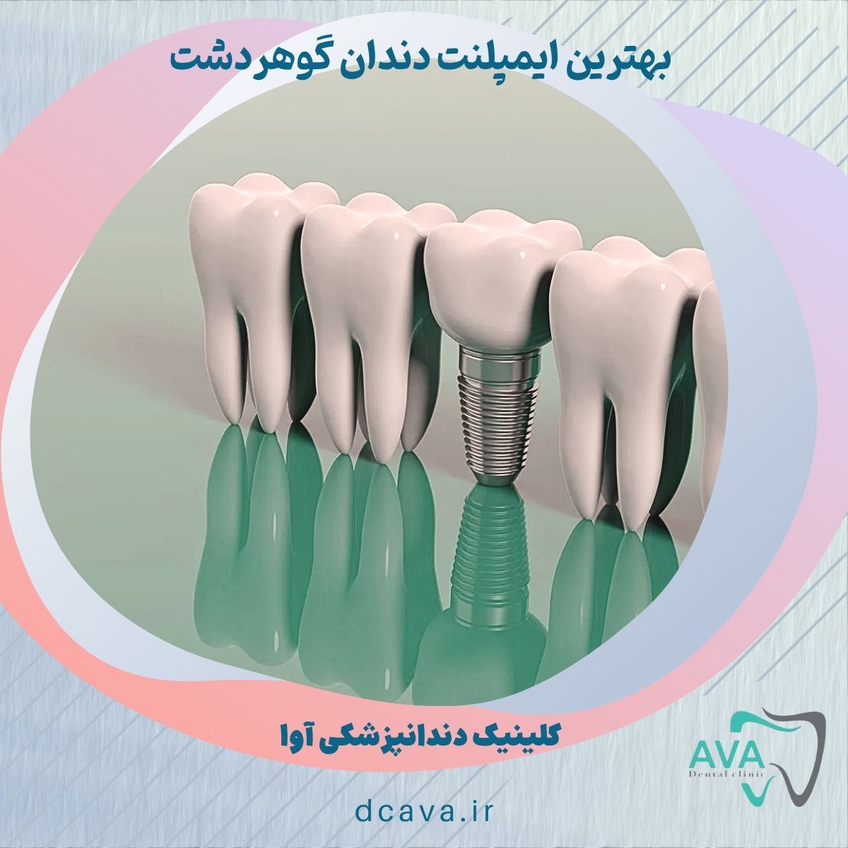 ایمپلنت دندان گوهردشت