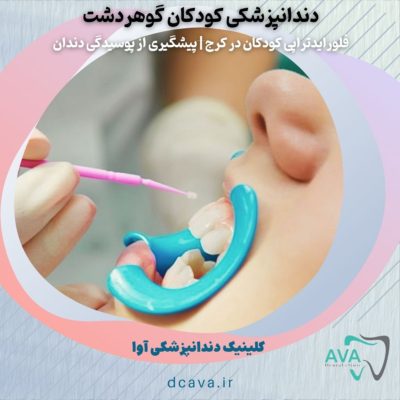 فلورایدتراپی کودکان در گوهردشت کرج | پیشگیری مطمئن از پوسیدگی دندان 6 فلورایدتراپی کودکان در کرج
