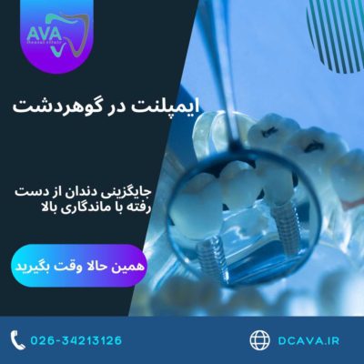 ایمپلنت در گوهردشت | جایگزینی دندان از دست رفته با ماندگاری بالا در کلینیک دندانپزشکی آوا 2 ایمپلنت در گوهردشت