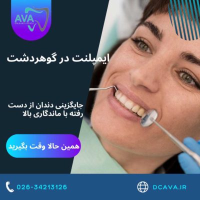 ایمپلنت در گوهردشت | جایگزینی دندان از دست رفته با ماندگاری بالا در کلینیک دندانپزشکی آوا 3 ایمپلنت در گوهردشت