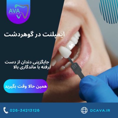 ایمپلنت در گوهردشت | جایگزینی دندان از دست رفته با ماندگاری بالا در کلینیک دندانپزشکی آوا 1 ایمپلنت در گوهردشت
