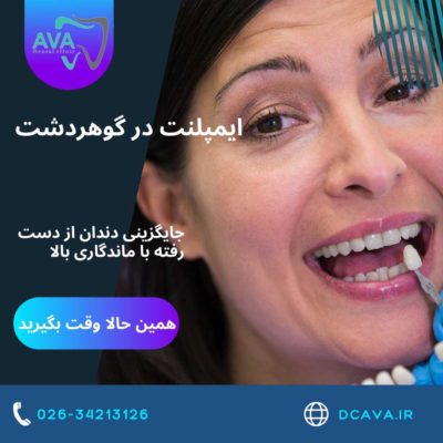 ایمپلنت در گوهردشت | جایگزینی دندان از دست رفته با ماندگاری بالا در کلینیک دندانپزشکی آوا 4 ایمپلنت در گوهردشت