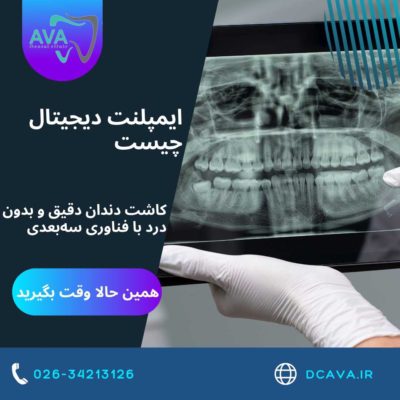 ایمپلنت دیجیتال چیست؟ | کاشت دندان دقیق و بدون درد با فناوری سهبعدی در کلینیک آوا 5 ایمپلنت دیجیتال چیست