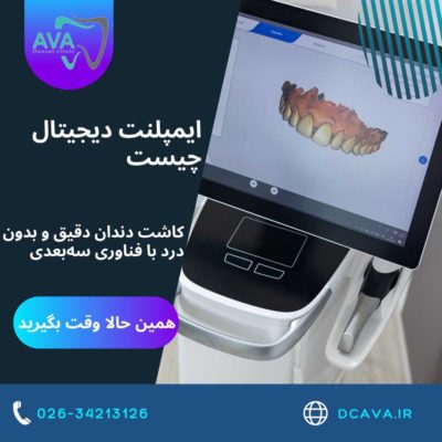 ایمپلنت دیجیتال چیست؟ | کاشت دندان دقیق و بدون درد با فناوری سهبعدی در کلینیک آوا 1 ایمپلنت دیجیتال چیست