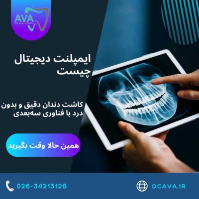 ایمپلنت دیجیتال چیست؟ | کاشت دندان دقیق و بدون درد با فناوری سهبعدی در کلینیک آوا 2 ایمپلنت دیجیتال چیست